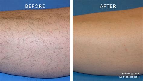 brazilian hair removal before and after
